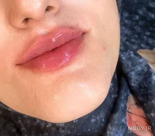 ✔️ | مرکز زیبایی و لیزر تزریق ژل لب مدل غنچه ای ❤️ + عکس و فیلم