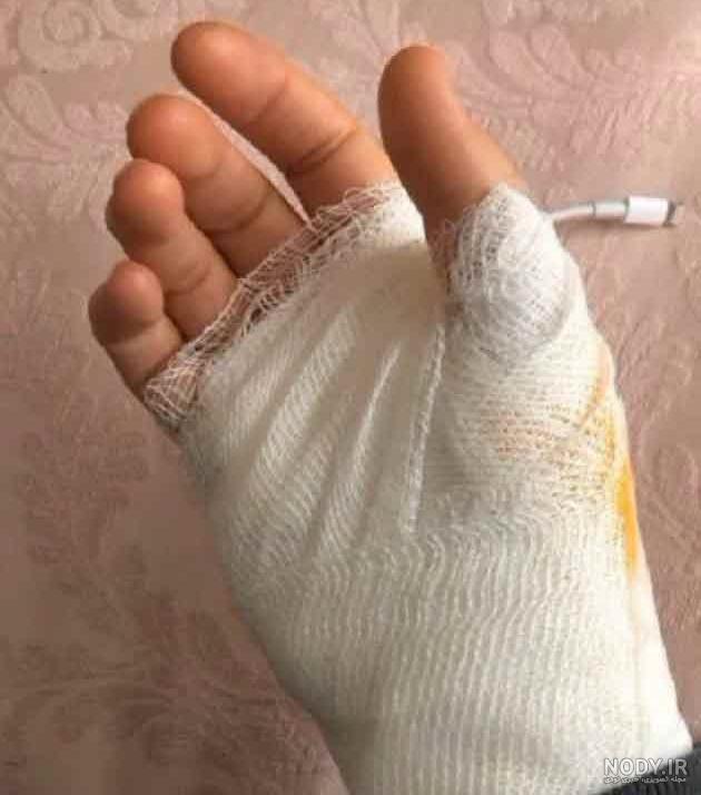 بریدگی کف دست | دست بریده شده با چاقو یا شیشه