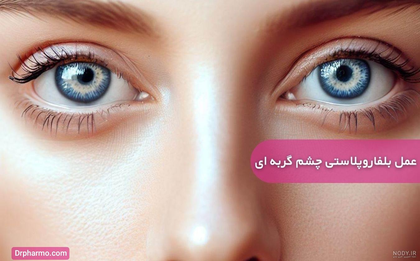 جراحی چشم گربه ای | روش های مختلف عمل+مزایا و معایب | دکتر الستی