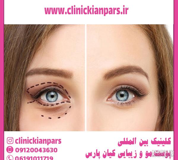 عمل درشت کردن چشم یا چشم گربه ای (جراحی کانتوپلاستی)