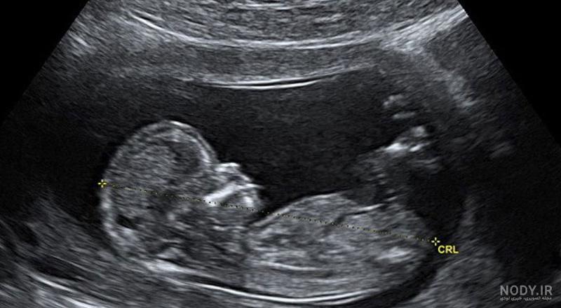 عکس جنین سه ماه دختر عکس جنین سه ماه دختر