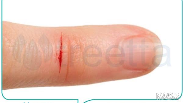 عکس/ زخم دست ترامپ خبرساز شد | سایت انتخاب