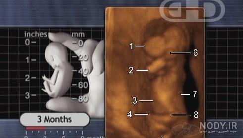 غربالگری و سلامت جنین در چه ماهی انجام می شود؟ غربالگری و سلامت جنین در چه ماهی انجام می شود؟