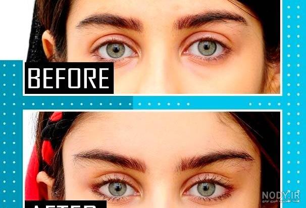 لیفت چشم گربه ای بدون جراحی 😊 - دکتر غزال یزدانی