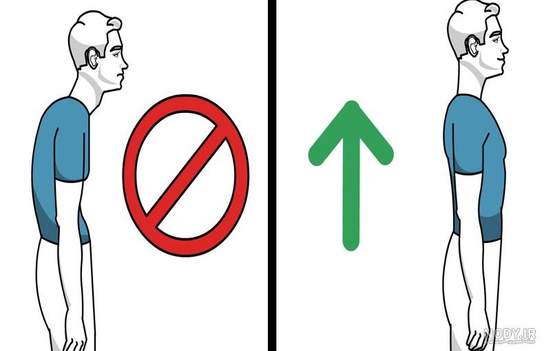 درمان قوز کمر (کیفوز یا گوژپشتی) در نوجوانان و بزرگسالان+عکس - کلینیک ارتوپدی کودکان|متخصص ارتوپد کودکان درمان قوز کمر (کیفوز یا گوژپشتی) در نوجوانان و بزرگسالان+عکس - کلینیک ارتوپدی کودکان|متخصص ارتوپد کودکان