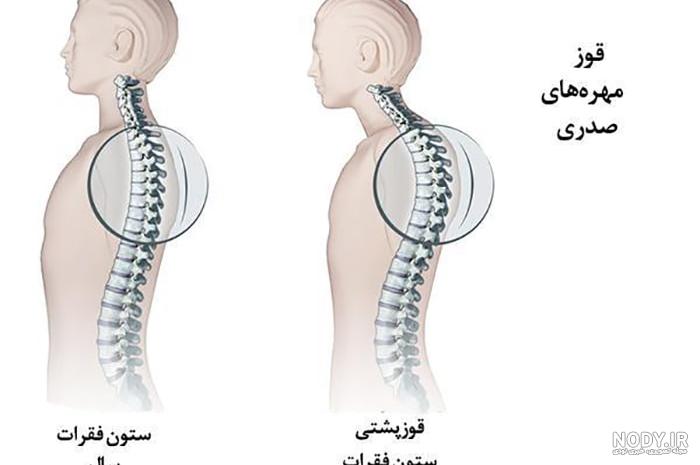 درمان قوز کمر یا گوژپشتی - تناسب آنلاین - تمرین اصلاحی برای رفع قوز کمر درمان قوز کمر یا گوژپشتی - تناسب آنلاین - تمرین اصلاحی برای رفع قوز کمر