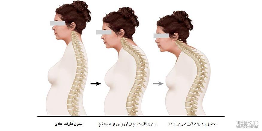 عکس از قوز کمر عکس از قوز کمر