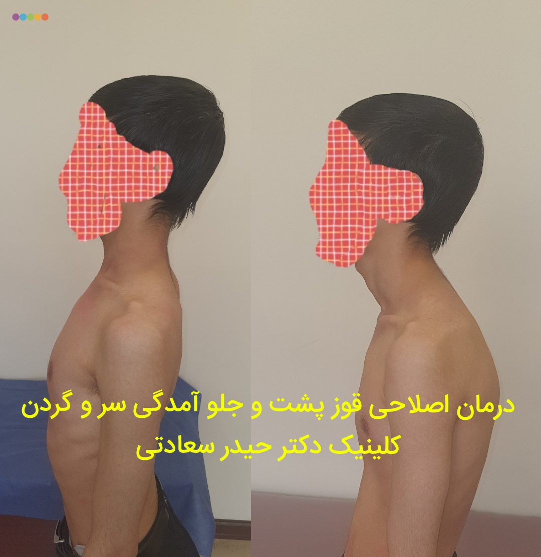 قوز کمر و پشت : درمان با فیزیوتراپی و ورزش قوز کمر و پشت : درمان با فیزیوتراپی و ورزش
