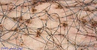 انواع شپش در انسان انواع شپش در انسان