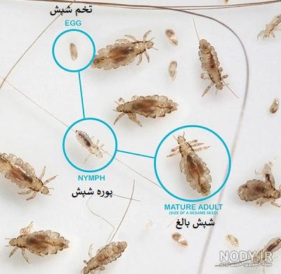 بررسی گام به گام بیماری شپش موی سر با عکس