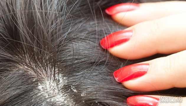 حشره شپش چیست؟ 5 راه از بین بردن این حشره مزاحم (+عکس)