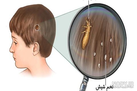 دستورالعمل درمان شپش سر – دریچه ای به دنیای دانستنی های سلامت دستورالعمل درمان شپش سر – دریچه ای به دنیای دانستنی های سلامت