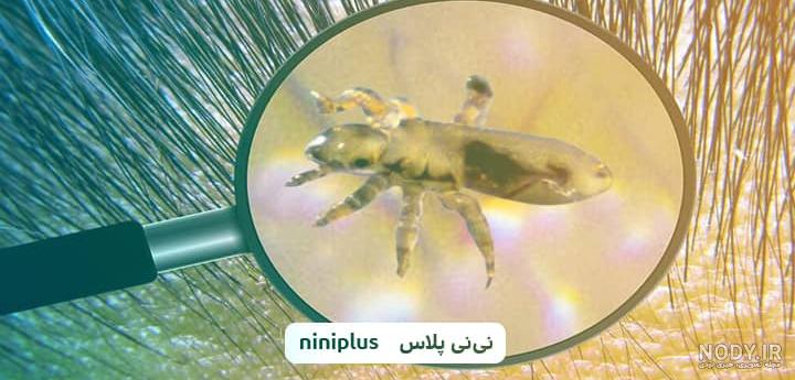 راحت ترین و موثرترین روش های درمان شپش سر - دکترنکست