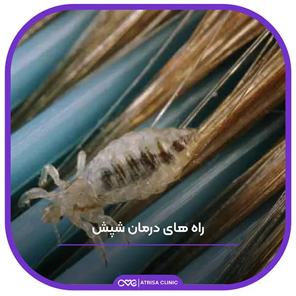 راه های انتقال شپش و روش درمان آن – فارماکالا