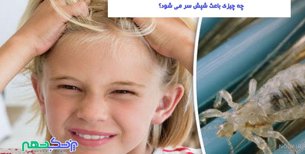 راهکار های فوری برای درمان شپش سر - کلینیک بین المللی پوست و مو زیبایی عظیمیه راهکار های فوری برای درمان شپش سر - کلینیک بین المللی پوست و مو زیبایی عظیمیه