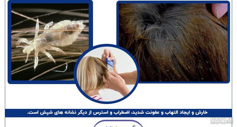 راه‌های درمان شپش سر چیست؟