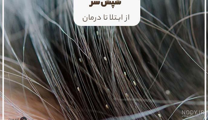 رشک عکس شپش سر - عکس نودی رشک عکس شپش سر - عکس نودی