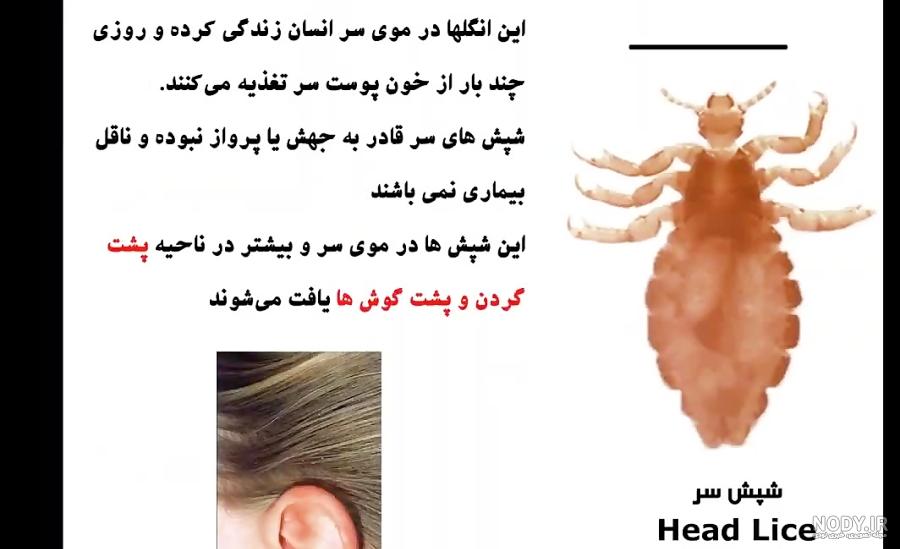 شرکت سمپاشی نگین دشت - چگونه می توان گزش شپش را شناسایی نمود؟ | سمپاشی نگین دشت شرکت سمپاشی نگین دشت - چگونه می توان گزش شپش را شناسایی نمود؟ | سمپاشی نگین دشت