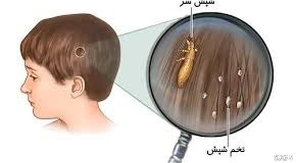شپش سر | شپش موی سر از تشخیص و علائم تا درمان 100 درصدی