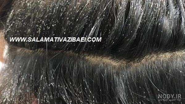 شپش سر در مدارس: پیشگیری و درمان با طب سنتی در آغاز سال تحصیلی - سایت دکتر  حسن اکبری