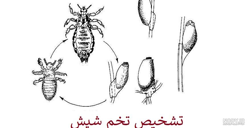 شپش سر چیست و چه علائمی دارد؟ + عکس شپش سر و تخم شپش سر