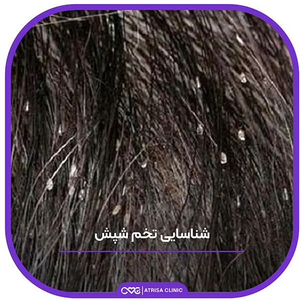 شپش چیست و چه کسانی بیشتر میگیرند؟