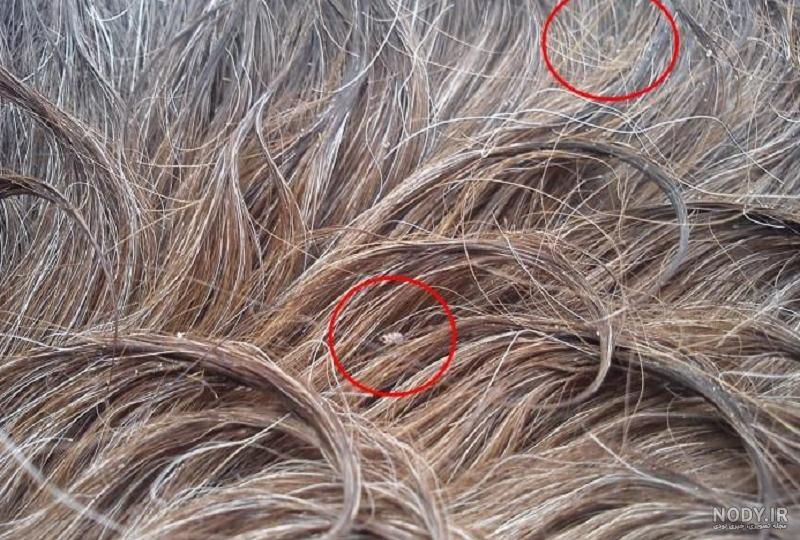 شکل شپش سر چگونه است؟ شکل شپش سر چگونه است؟