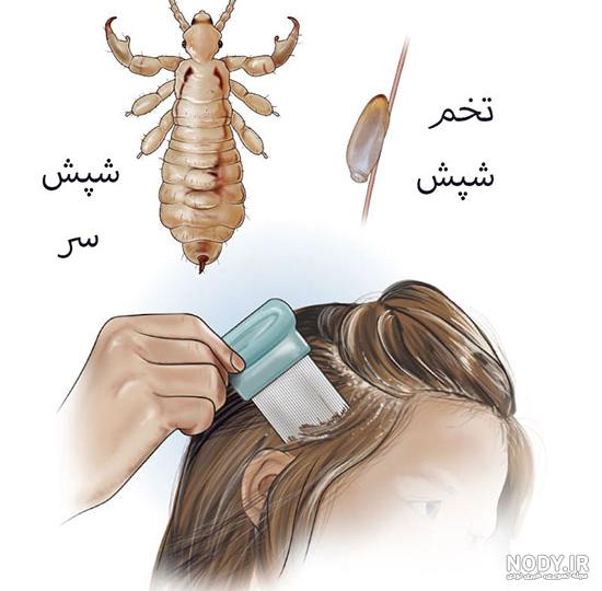 صورت شپش سر زیر میکروسکوپ! +عکس | جهان نيوز صورت شپش سر زیر میکروسکوپ! +عکس | جهان نيوز