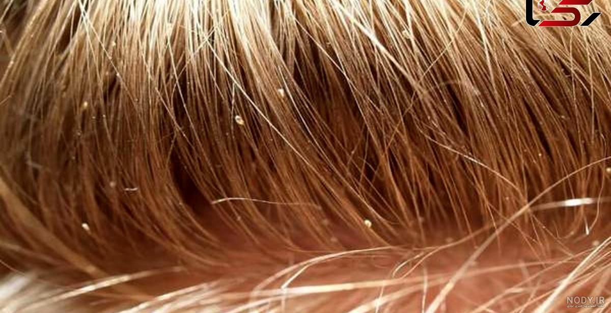 علائم شپش سر چیست؟ طول عمر و نحوه انتقال رشک مو - دکترمایکو علائم شپش سر چیست؟ طول عمر و نحوه انتقال رشک مو - دکترمایکو