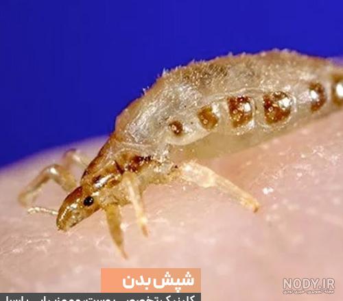 عکس جای نیش شپش بدن عکس جای نیش شپش بدن