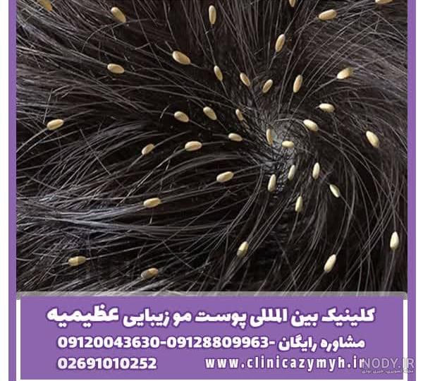 عکس شپش سر عکس شپش سر