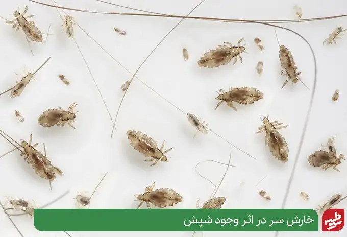 عکس شپش سر از نزدیک عکس شپش سر از نزدیک
