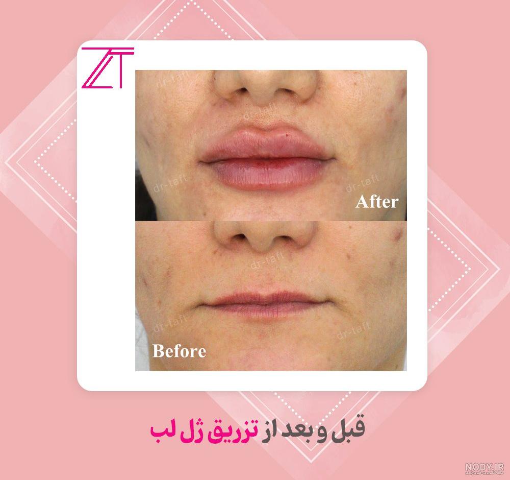 عکس ژل لب طبیعی