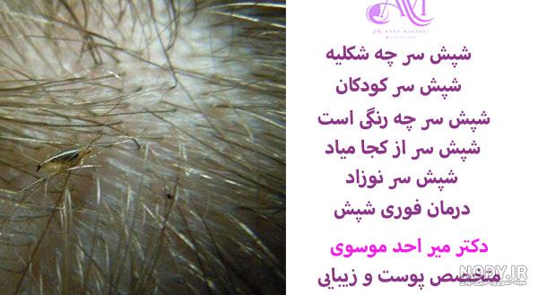 فرق شپش سر با شپش برنج چیست؟