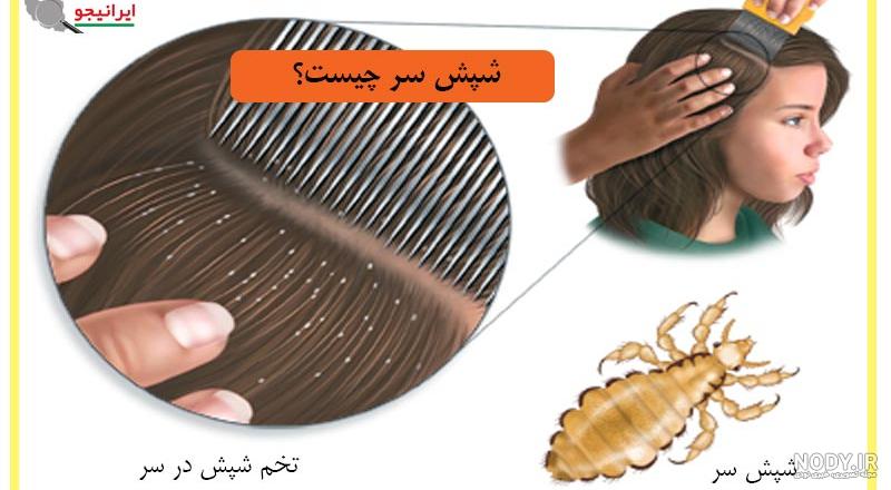 گالری عکس شپش
