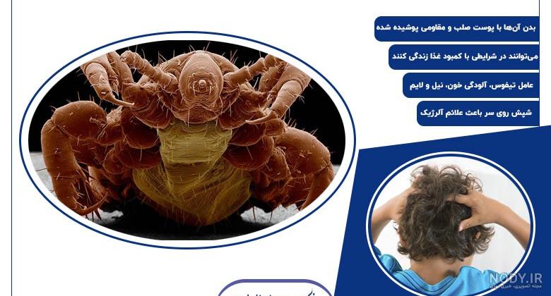 گالری عکس شپش