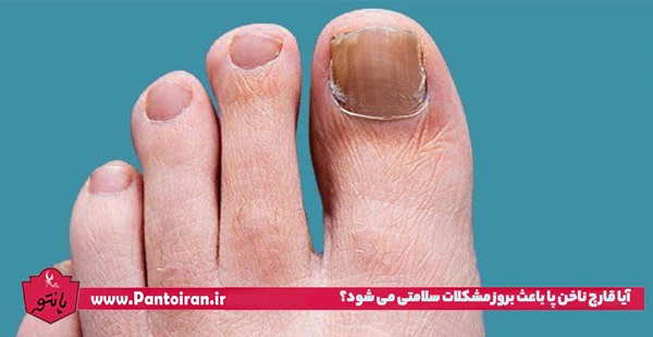 عفونت قارچی ناخن || راهکارهای پیشگیری از عفونت قارچی ناخن عفونت قارچی ناخن || راهکارهای پیشگیری از عفونت قارچی ناخن