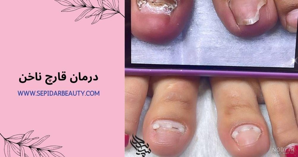 علت ایجاد قارچ ناخن دست و پا چیست؟درمان خانگی و دارویی قارچ ناخن | پذیرش۲۴ علت ایجاد قارچ ناخن دست و پا چیست؟درمان خانگی و دارویی قارچ ناخن | پذیرش۲۴