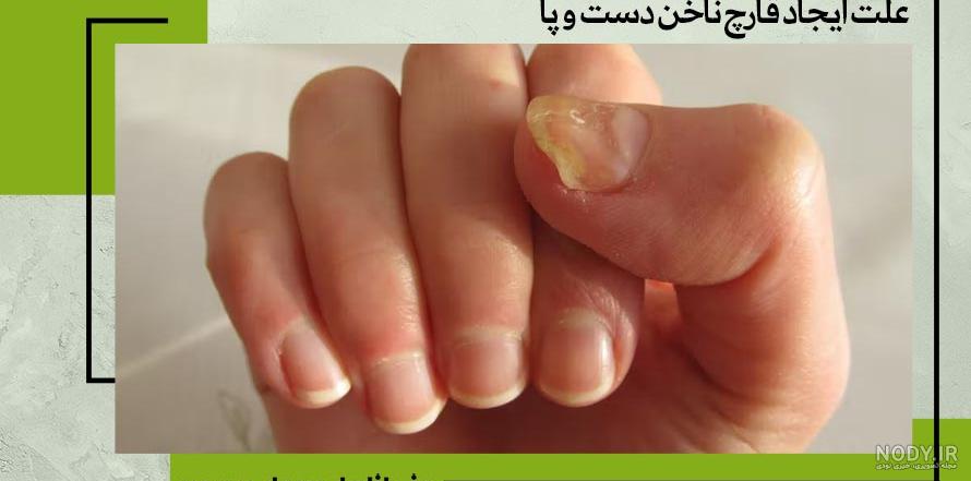 عکس ناخن قارچی - عکس نودی عکس ناخن قارچی - عکس نودی