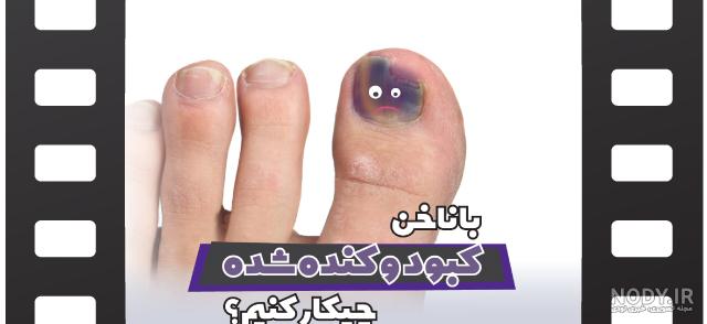 عکس ناخن شکسته کاشت