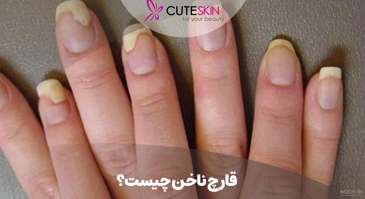 قارچ ناخن : علت و علائم آن چیست؟ چگونه قارچ ناخن را درمان کنیم؟ - آکادمی کاشت ناخن قارچ ناخن : علت و علائم آن چیست؟ چگونه قارچ ناخن را درمان کنیم؟ - آکادمی کاشت ناخن