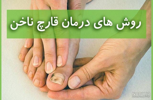 قارچ ناخن چیست و چرا به وجود می آید؟ - ماه خاتون قارچ ناخن چیست و چرا به وجود می آید؟ - ماه خاتون