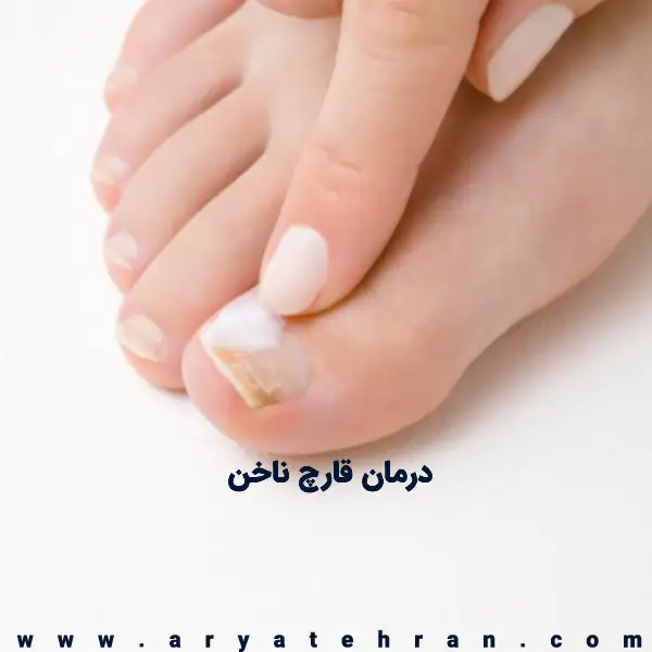 قارچ ناخن چیست؟ علت و راهکارهای درمان خانگی این عفونت قارچ ناخن چیست؟ علت و راهکارهای درمان خانگی این عفونت