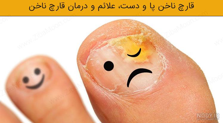 قارچ ناخن کاشت شده + راه های پیشگیری و درمان - ژوتن قارچ ناخن کاشت شده + راه های پیشگیری و درمان - ژوتن