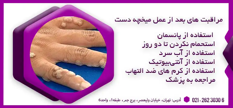 عکس ریشه میخچه انگشت دست - عکس نودی