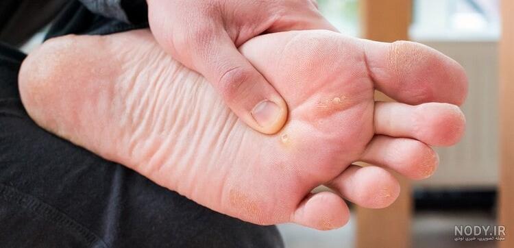 از بین بردن ریشه میخچه - مرکز جراحی، پوست، مو و لیزر آلا