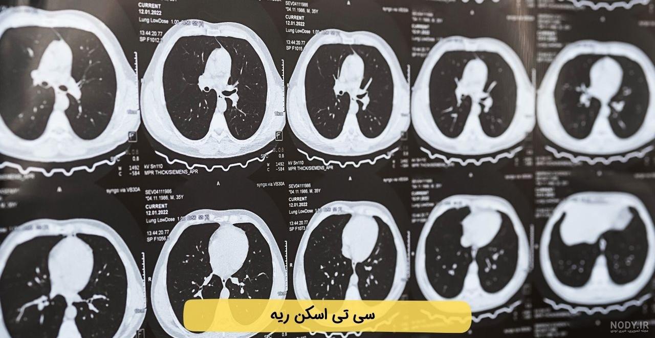 اسکن ریه | انواع اسکن ریه | علت نیاز به اسکن هسته ای ریه | آمادگی برای اسکن  ریه