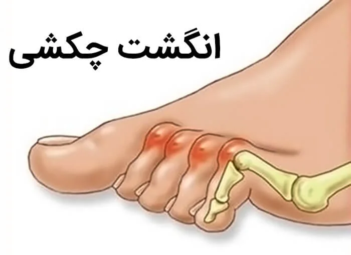 انواع میخچه + {درمان فوری و خانگی میخچه دست و پا} | دارودراگ انواع میخچه + {درمان فوری و خانگی میخچه دست و پا} | دارودراگ