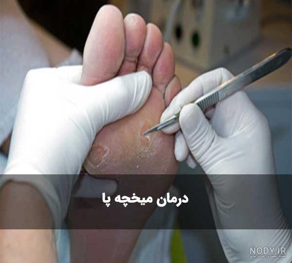 بهترین راه درمان میخچه پا در منزل - جراحی میخچه پا و عکس میخچه پا | دکتر انتظاری بهترین راه درمان میخچه پا در منزل - جراحی میخچه پا و عکس میخچه پا | دکتر انتظاری