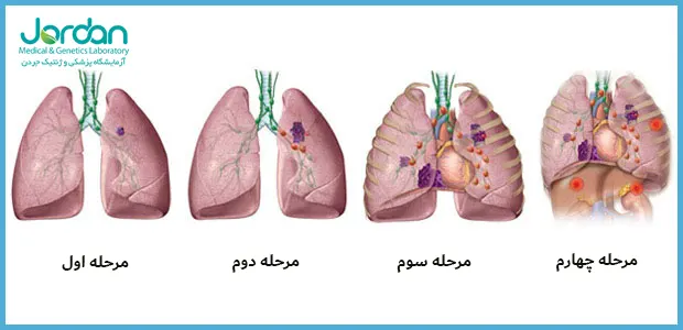 تصویری منسوب به ریه یک فرد بیمار کرونایی شدید +عکس - 16.04.2020, اسپوتنیک ایران تصویری منسوب به ریه یک فرد بیمار کرونایی شدید +عکس - 16.04.2020, اسپوتنیک ایران